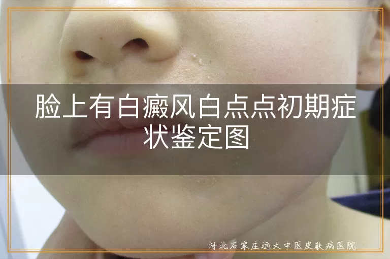 脸上有白癜风白点点初期症状鉴定图