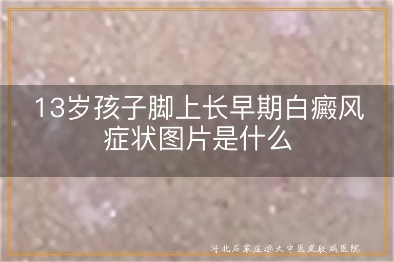 13岁孩子脚上长早期白癜风症状图片是什么