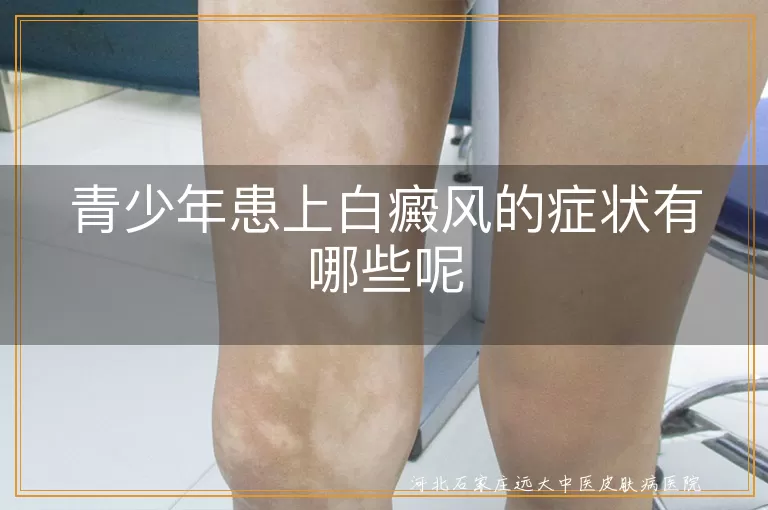 `青少年白癜风初期表现,青少年白斑早期症状,青少年白癜风典型特征`