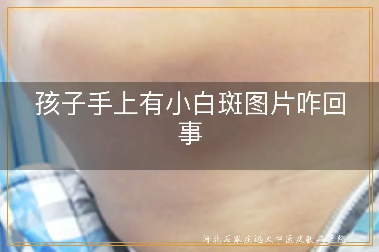 `孩子手上出现白斑是怎么回事,儿童手部白斑图片鉴别,儿童白癜风早期症状图片`