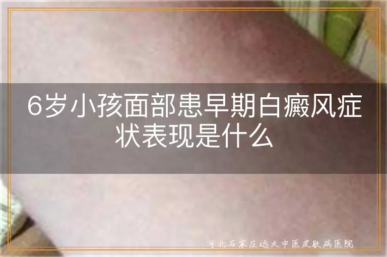 6岁小孩面部患早期白癜风症状表现是什么