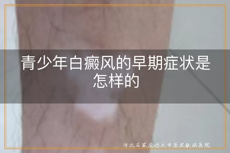 青少年白癜风的早期症状是怎样的