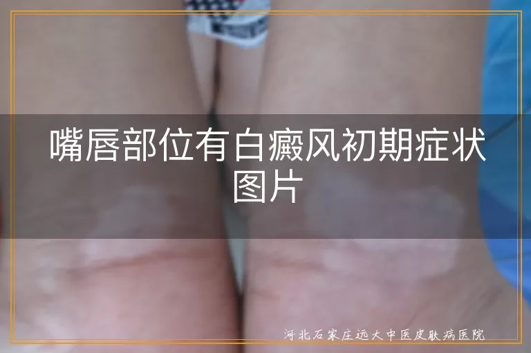 嘴唇白斑初期如何识别,唇边白癜风能治好吗,早期嘴唇白癜风表现图