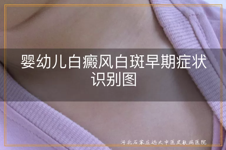 新生儿白斑初迹象图,白癜风宝宝早期症状,婴幼儿白癜风识别图