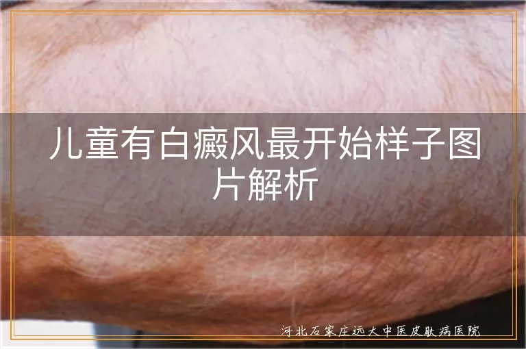 早期儿童白斑形态图片,白癜风初期表现照片,婴幼儿白斑病症状图片