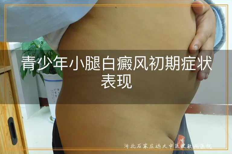 青少年小腿白斑变化,青春期白癜风首现迹象,儿童腿部早期白斑