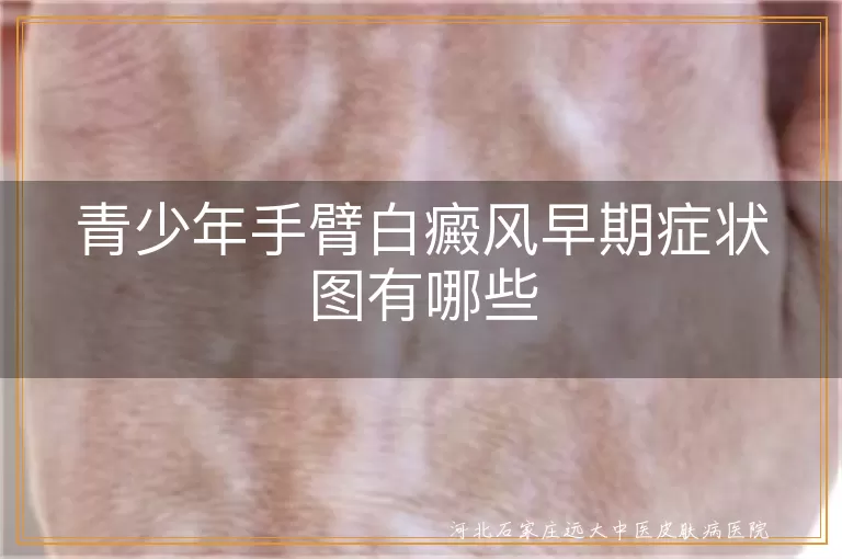 青少年手臂白斑初期表现图,白癜风手臂症状照片,手臂白癜风小白点图片
