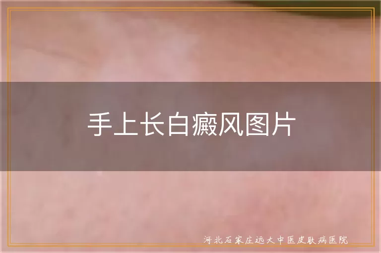 手上白癜风初期症状图,手部白斑对比照片,手指长白癜风图