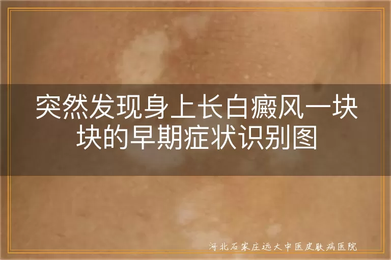 白癜风早期斑块自测图,身上白斑初期症状识别,白癜风发现时间对照图谱
