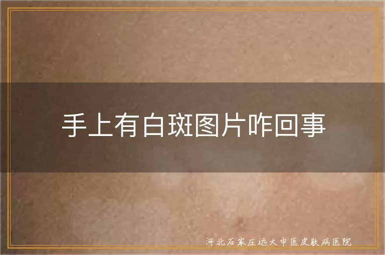 手上有白斑图片咋回事