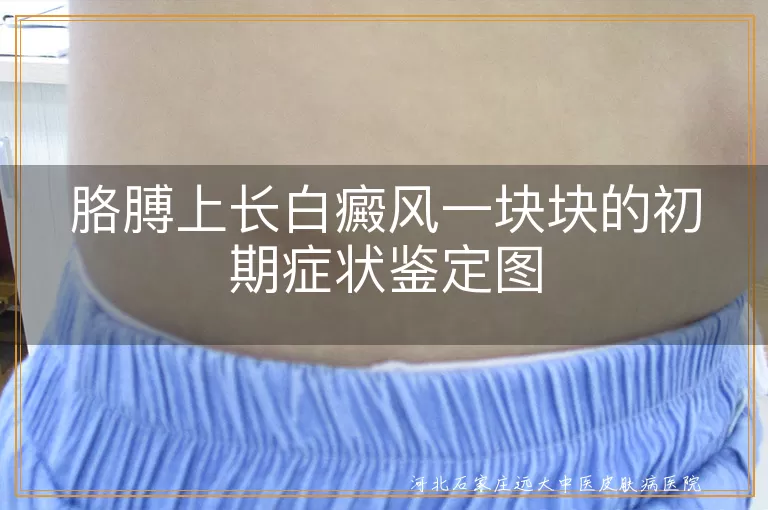 胳膊初期白斑识别图,手臂白癜风初期图片,胳膊白癜风成块症状