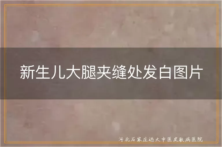 新生婴幼儿大腿根白癜风,婴儿股间白斑照片,婴儿夹缝白癜风症状