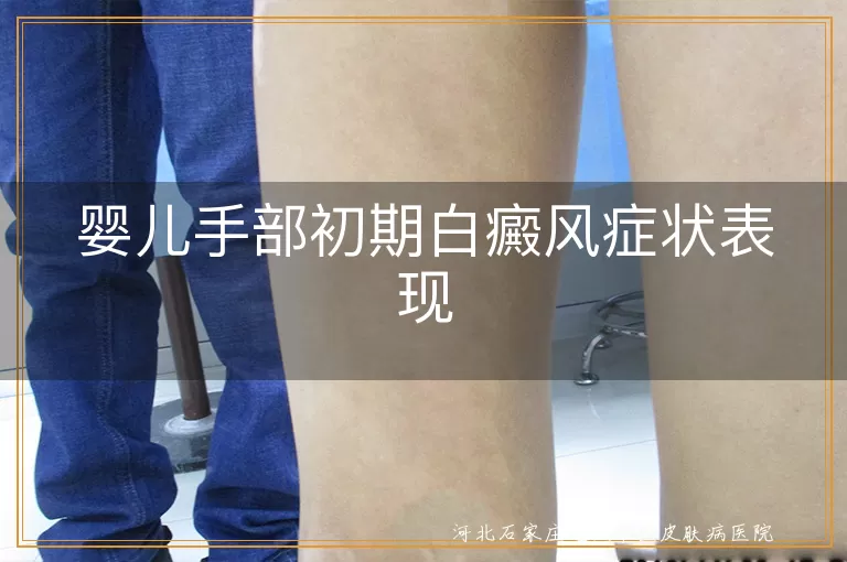 婴儿手部白斑初期表现,白癜风手部早期信号,新生儿手部白斑鉴别