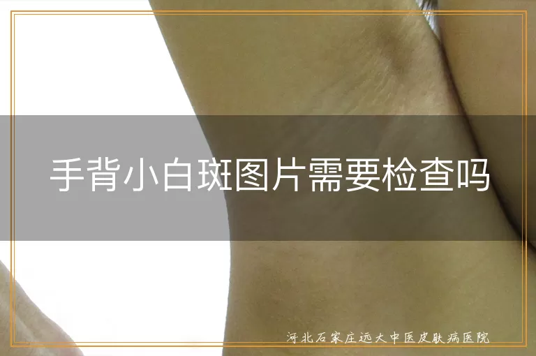 手背小白斑图片需要检查吗