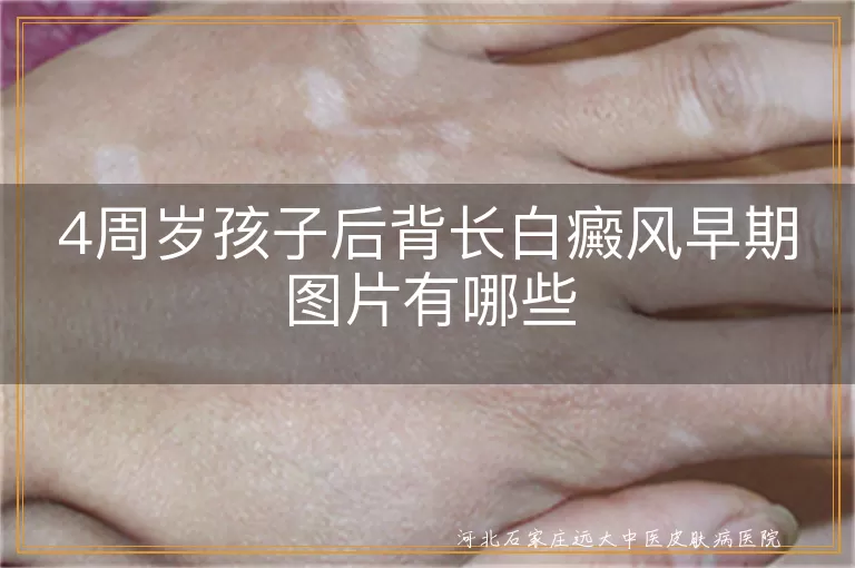 4周岁孩子后背长白癜风早期图片有哪些