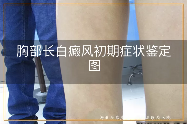 胸部白斑闪电扩散迹象证,胸部早期白癜风诊断实拍图,前胸隐匿白癜风初期症状图