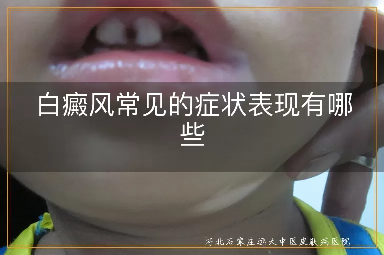 白癜风常见的症状表现有哪些