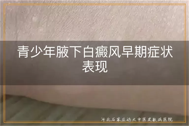 青少年腋下白癜风早期症状表现