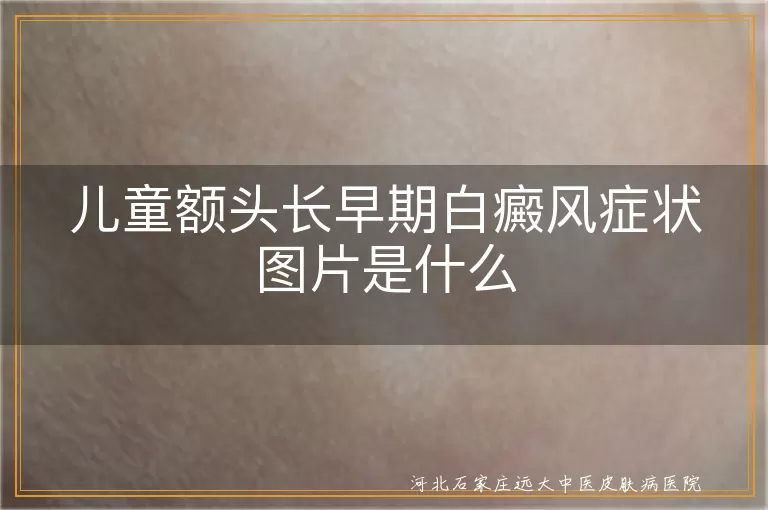 儿童额头长早期白癜风症状图片是什么