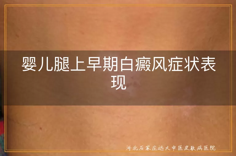 婴儿腿部白斑早期症状,宝宝白癜风初期特征,婴幼儿腿上白癜病变
