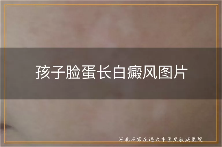 孩子面部白斑图片识别,幼儿白癜风早期照片,宝宝脸蛋白斑症状对比