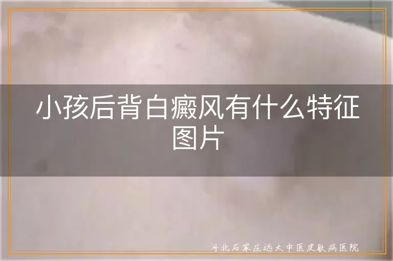 儿童后背白斑初期照片,白癜风早期儿童背部图像,小儿背部白癜风特征照片