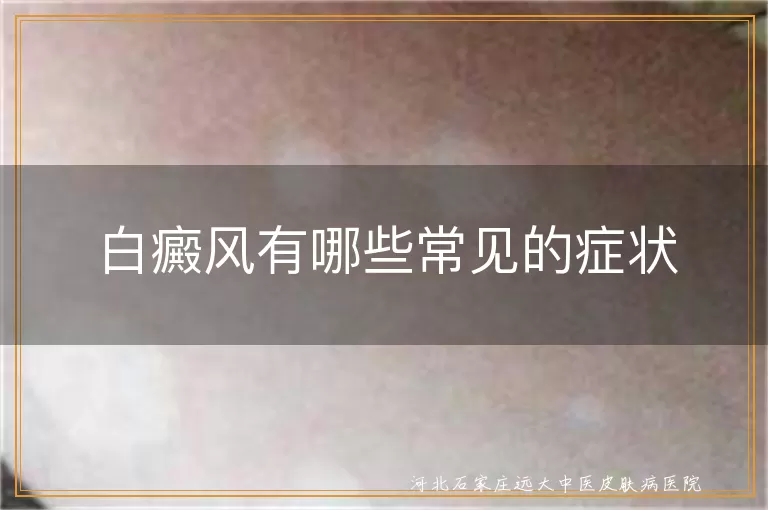 白癜风有哪些常见的症状