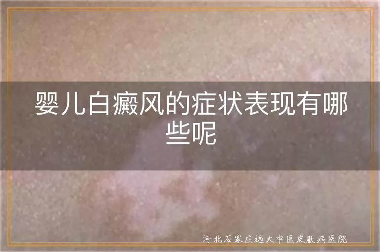 婴儿白癜风的症状表现有哪些呢