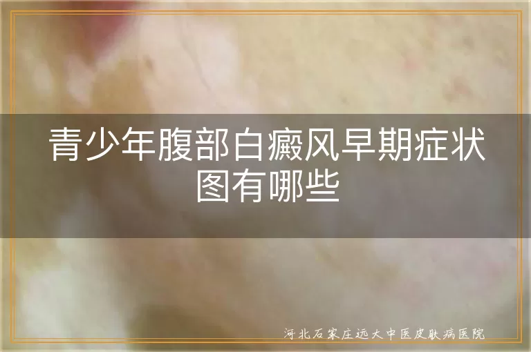青少年腹部白癜风早期症状图有哪些