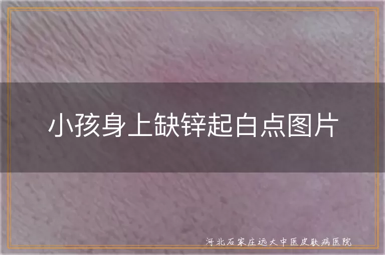 儿童缺锌鉴别白癜风白斑,宝宝白斑缺锌与白癜风对比,缺锌白点误诊为白癜风图片分析