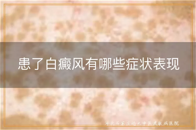 白癜风初期肤色改变征兆,皮肤白斑扩散特征解析,白癜风病情进展警示信号