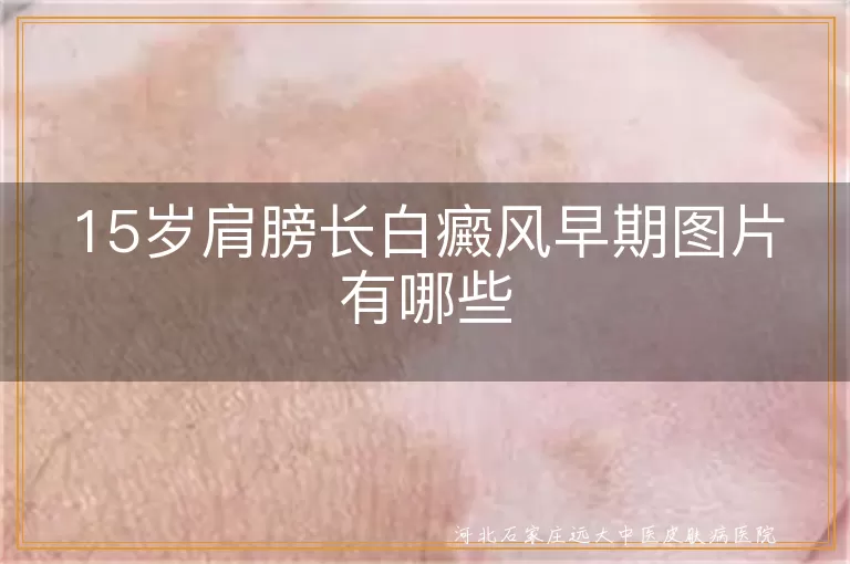15岁肩膀早期白癜风症状,青少年肩膀上初期白斑照片,白癜风早期肤色变浅
