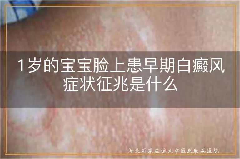 宝宝脸上早期白斑征兆,婴幼儿白癜风初期特征,一岁幼儿面部白斑识别