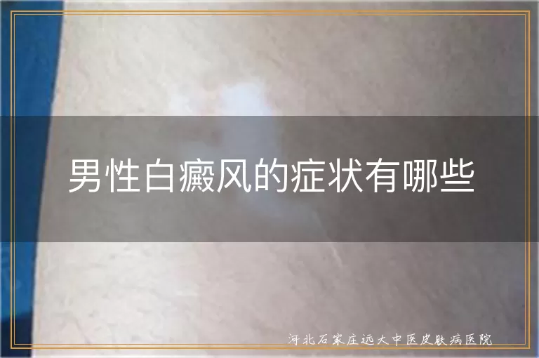 男性白癜风早期白斑特点,白癜风初期大面积扩散征兆,男性面部与白斑形态特征