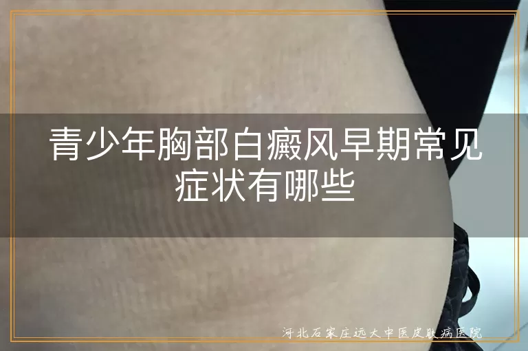 青少年胸部白癜风早期常见症状有哪些