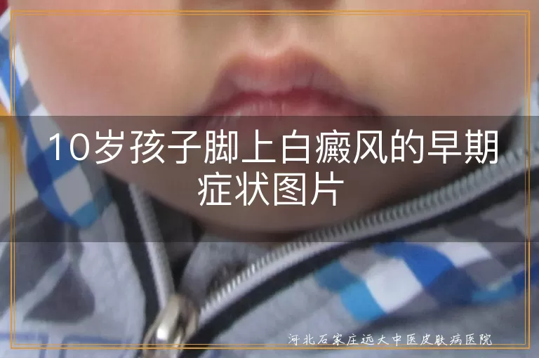 `10岁孩子脚白斑初期图示,幼儿足部白癜风先兆图解,儿童脚部白斑早期症状照片`