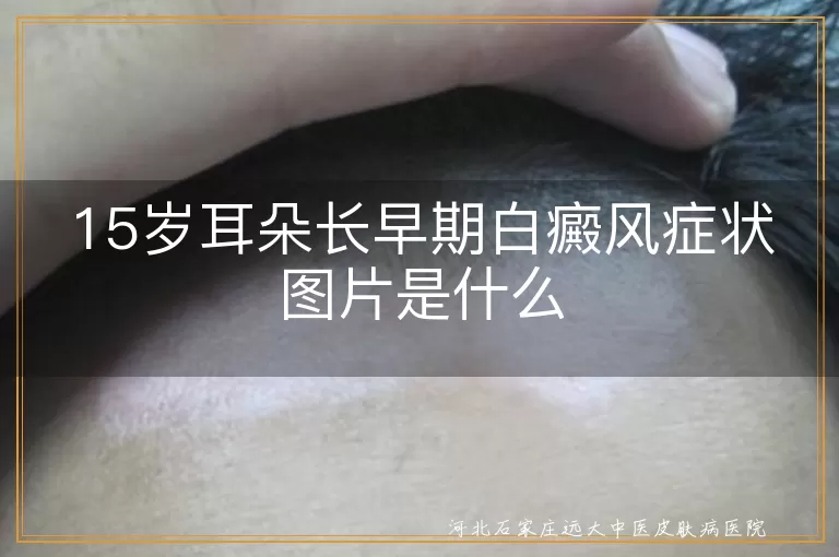 15岁耳朵长早期白癜风症状图片是什么
