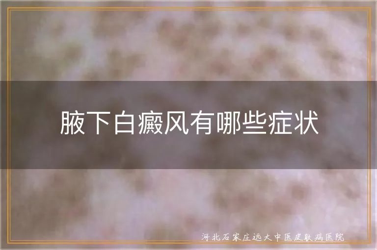 腋下白癜风有哪些症状