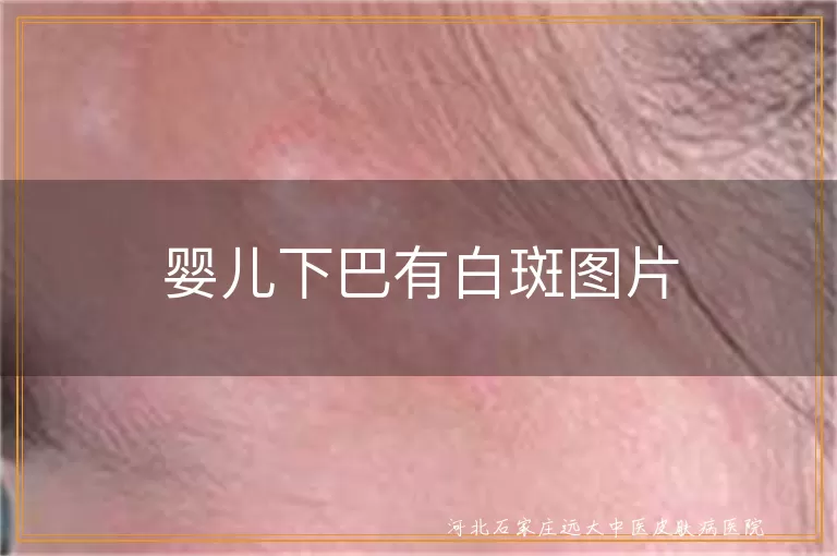 婴儿下巴有白斑图片