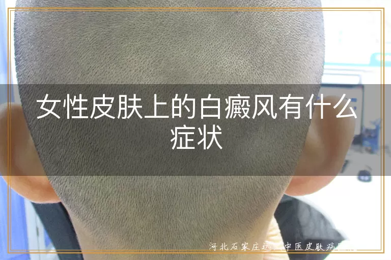 女性皮肤上的白癜风有什么症状