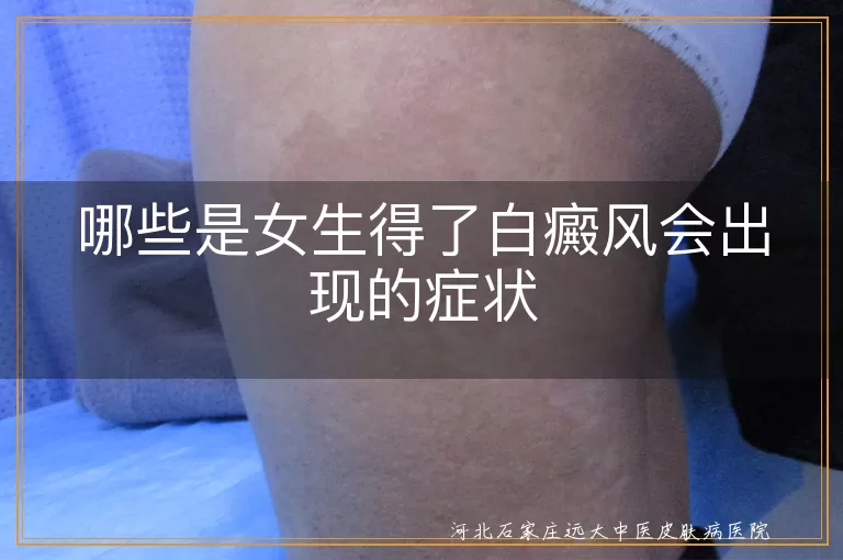哪些是女生得了白癜风会出现的症状