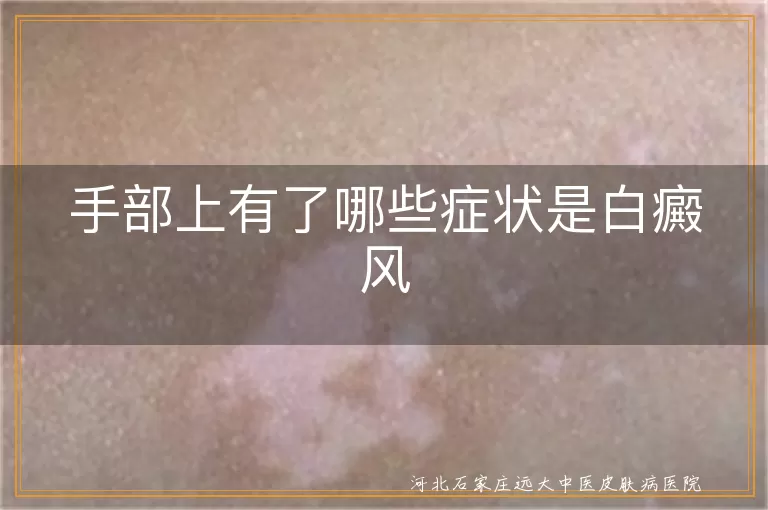 手部上有了哪些症状是白癜风