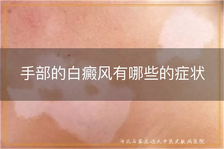 手部的白癜风有哪些的症状