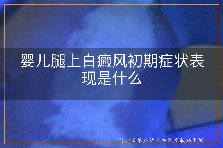 婴儿腿上白癜风初期症状表现是什么