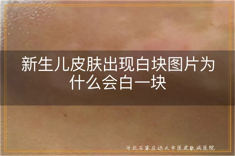 新生儿白癜风早期症状有哪些,出生宝宝白块图片会是白斑吗,婴儿皮肤白色斑块是不是白癜风