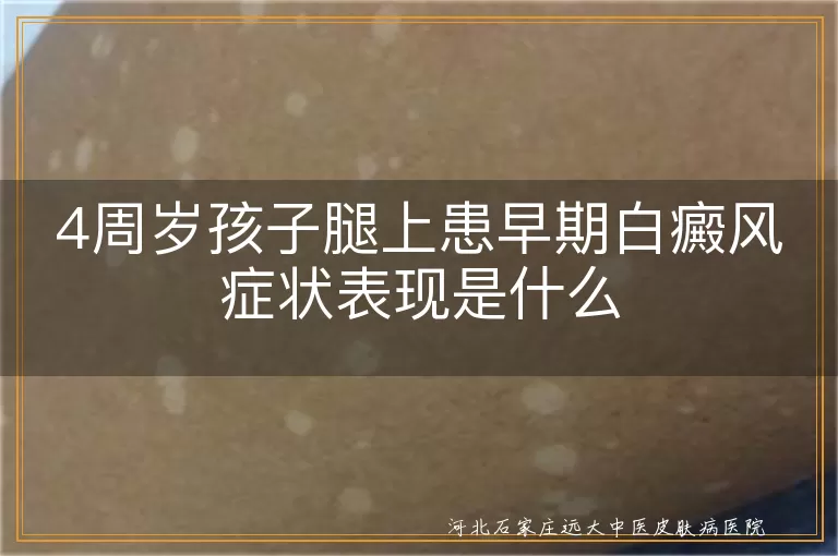 4岁早发腿部白斑,幼儿白癜风初期像啥,幼儿腿白斑特征分析