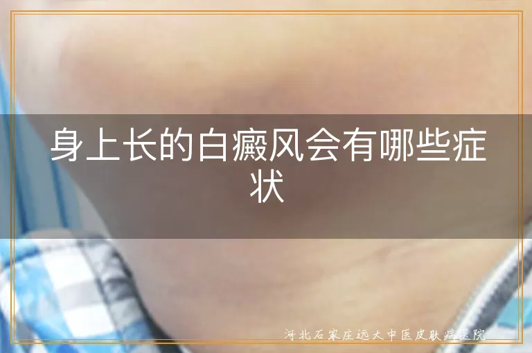 白癜风早期表现有哪些,白斑扩散前兆征兆,白癜风症状识别要点