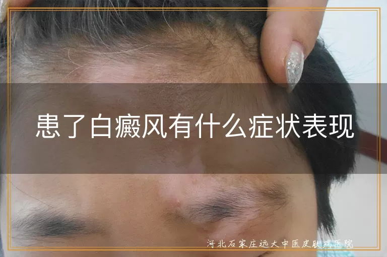 白癜风初期白斑多呈现,面部白斑边界分明会是白癜风吗,白癜风白斑对阳光敏感表现