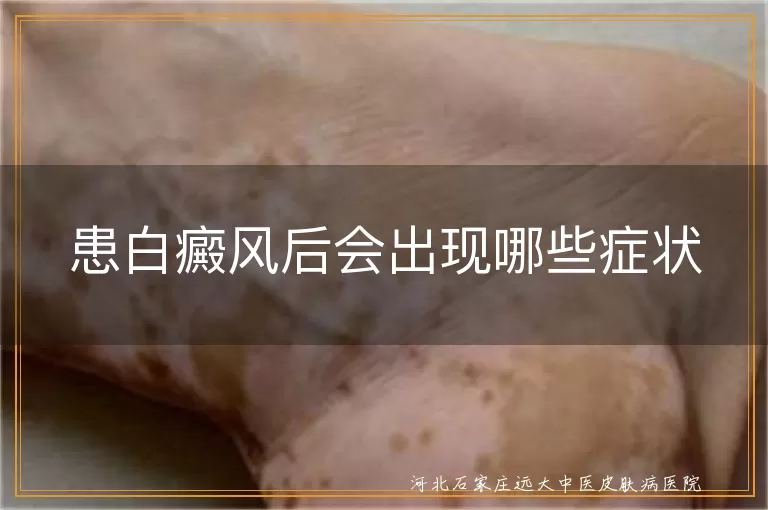 白癜风初期白斑症状,白癜风扩散发展变化,白斑外观特征鉴别