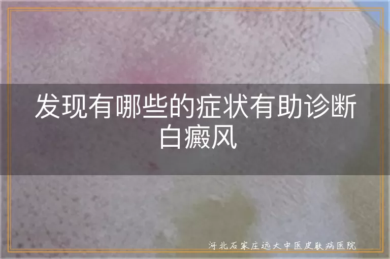 白斑边界模糊警惕白癜风,白癜风早期色素减退信号,无痛性白斑持续扩大需排查白癜风